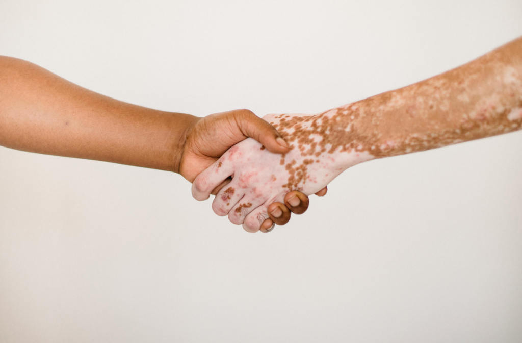 Psoriāze: cēloņi, uzturs un iespējas veselības uzlabošanai